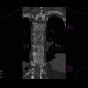 Skeletal changes in myeloma, thoracic spine and ribs: CT - Computed tomography